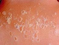 Шелушится кожа на ногах у ребенка — причины